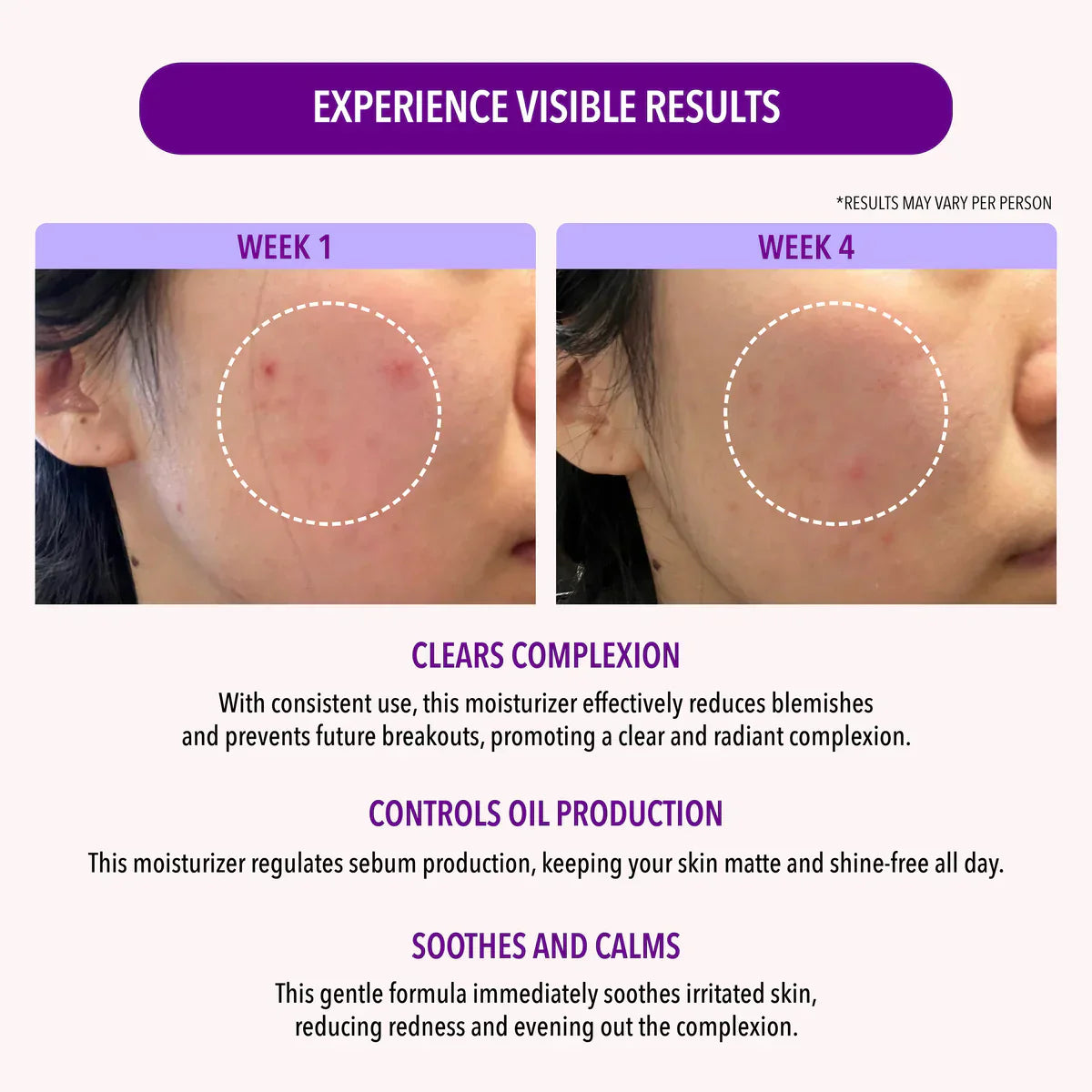 CREMA FACIAL HIDRATANTE OIL CONTROL 10% NIACINAMIDA - MOIRA