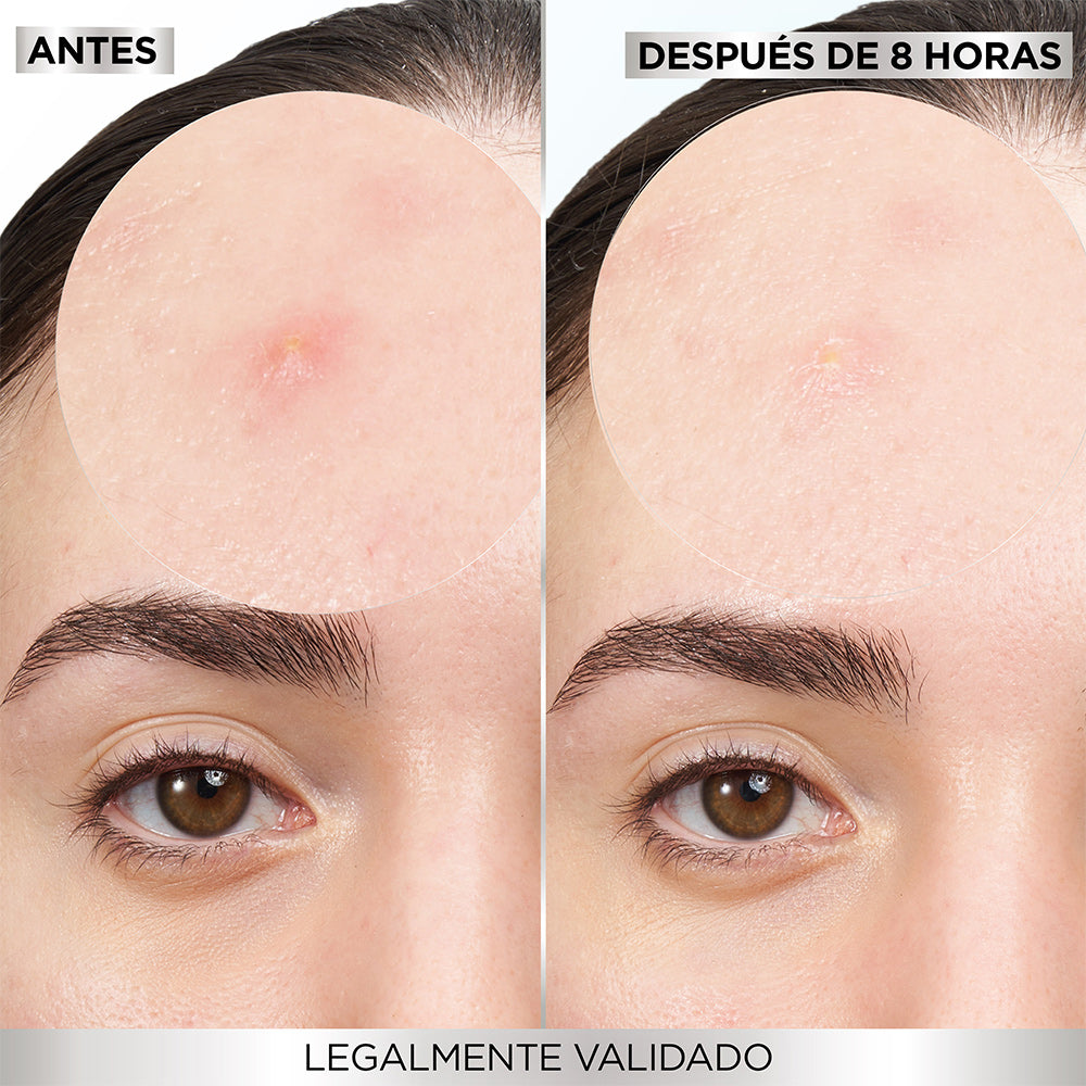 PARCHES PARA ACNÉ - GARNIER SKIN ACTIVE