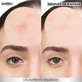PARCHES PARA ACNÉ - GARNIER SKIN ACTIVE